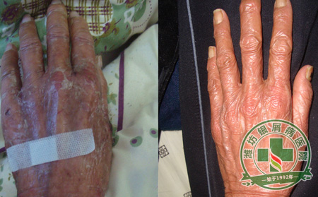 热点关注:银屑病因有哪些?