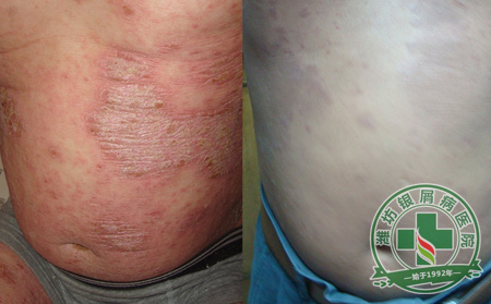 银屑病治疗期间应该注意什么？