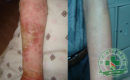 患者关注:如何降低银屑病遗传几率?