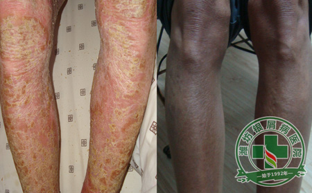 花开五月女人心,银屑病护理要当心