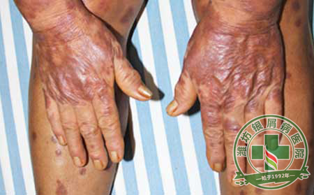 春天来了，银屑病防复发工作迫在眉睫！