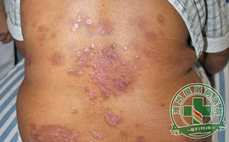 哪些食物能够诱发或者加重银屑病病情?