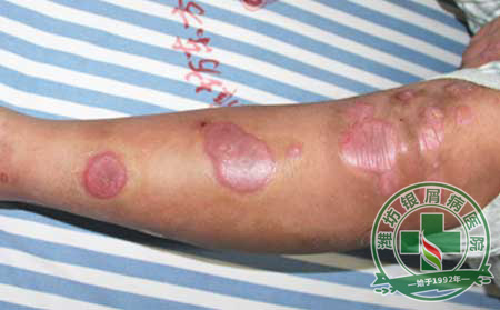 济南银屑病医院五一特别奉献:睡出来的可以肌肤