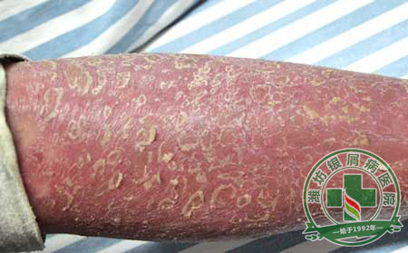 岁月静可以,我心安然——牛皮癣治可以女孩的自述