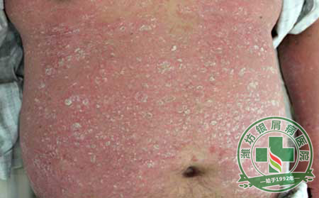 热点探讨:银屑病遗传≠银屑病传染