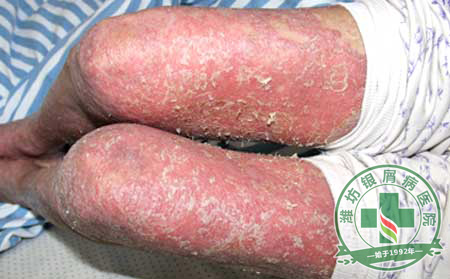 济南治疗银屑病大概要花多少钱？