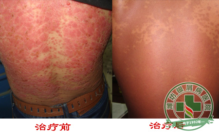 减少牛皮癣病症反复怎样做良有效