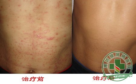 减少牛皮癣病症反复怎样做良有效