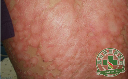 治疗银屑病为什么要找专科医院?