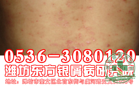 济南银屑病医院呵护女性皮肤健康