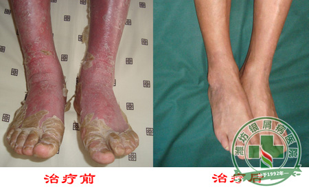 女性牛皮癣病员防病症复发要怎样做