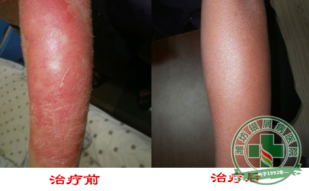 对牛皮癣辅助治疗方法会有哪些呢