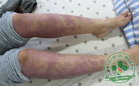 有牛皮癣平时还能戴首饰吗