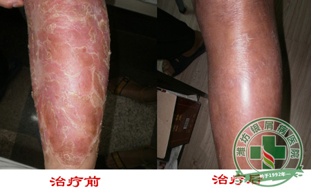 银屑病病员在冬季护理皮肤要点有什么