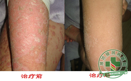 银屑病病员在冬季护理皮肤要点有什么