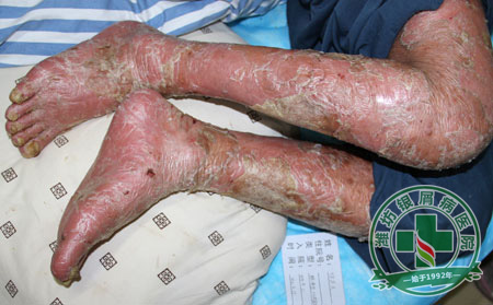牛皮癣病员常用电脑对病情有坏处吗
