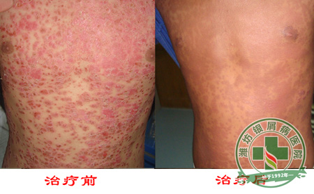 牛皮癣病员怎样预防过敏加重病症可以呢