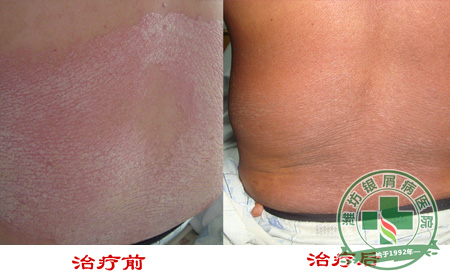 牛皮癣病员怎样预防过敏加重病症可以呢