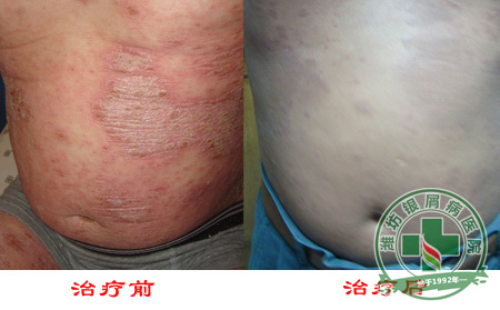 为啥银屑病为什么久治不愈