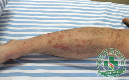 牛皮癣病员结婚怀孕要注意事项有哪些