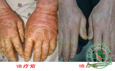 冬季牛皮癣病员治疗应注意问题