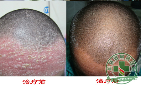 滥用牛皮癣其他方的危害是什么-济南如何治疗牛皮癣