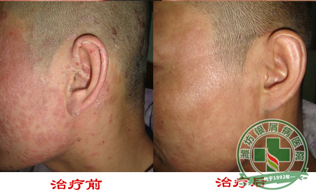 治疗牛皮癣的其他方我们要如何看待-济南银屑病专科医院