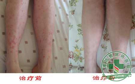 济南银屑病医院提醒治疗期注意
