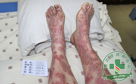 牛皮癣患者吃蜂蜜有可以处吗-山东银屑病医院