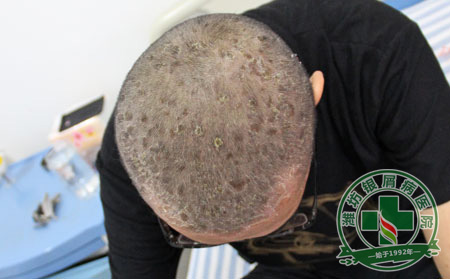 牛皮癣患者要警惕感染加重疾病-山东银屑病医院