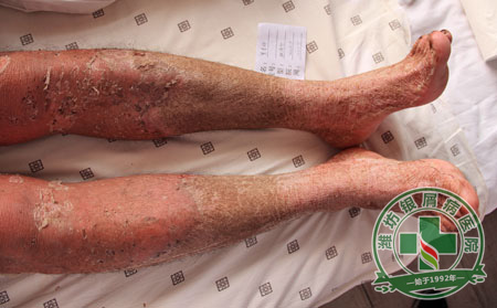 牛皮癣患者吃黄瓜也可以排毒吗-济南牛皮癣医院