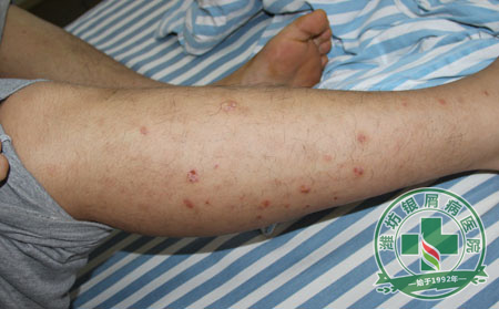 牛皮癣患者吃哪些食物可以一些呢-山东银屑病医院