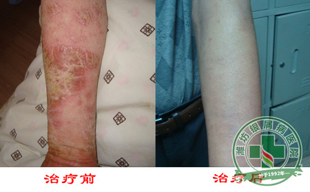 济南银屑病医院讲解诱发因素