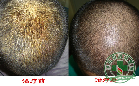 如何去护理寻常型牛皮癣呢-济南如何治疗牛皮癣