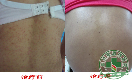 牛皮癣患者可以吃莲子吗-济南银屑病医院