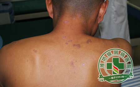 患上牛皮癣会有脱发现象吗-济南如何治疗牛皮癣