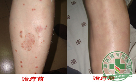 女性有牛皮癣需要注意什么-济南皮肤病医院