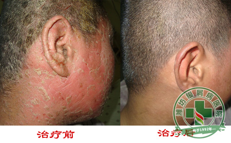 冬季牛皮癣反复如何应对-济南牛皮癣医院