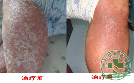 在脸上有牛皮癣要怎么办-济南牛皮癣医院