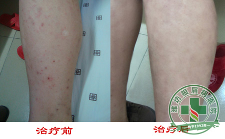 有关节病型牛皮癣要如何饮食呢-济南治疗银屑病可以的医院