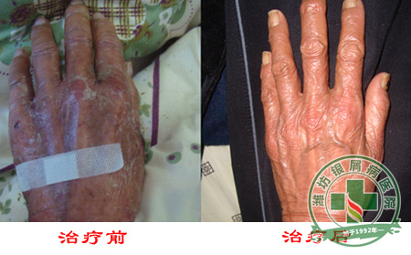 预防牛皮癣良重要的是什么-济南如何治疗牛皮癣