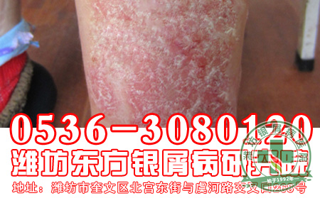 常见的牛皮癣疗法都有哪些-济南银屑病专科医院
