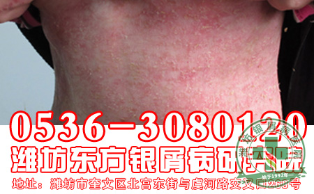 会让牛皮癣加重的原因是什么-济南银屑病专科医院