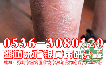 良有效的中医治疗牛皮癣的方法-山东银屑病医院