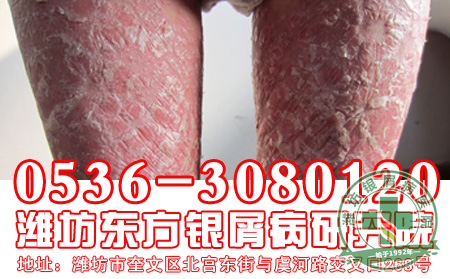 良有效的中医治疗牛皮癣的方法-山东银屑病医院