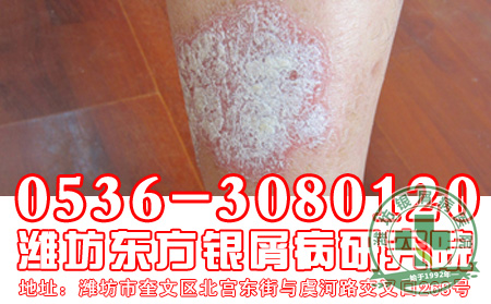 你知道治疗牛皮癣的误区吗-济南牛皮癣医院