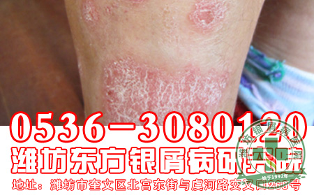 牛皮癣都受什么病因影响-济南银屑病专科医院