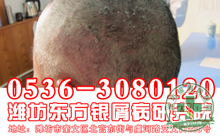 牛皮癣都受什么病因影响-济南银屑病专科医院