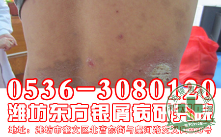 如何对牛皮癣进行治疗以及预防-济南银屑病专科医院