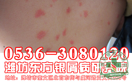 如何对牛皮癣进行治疗以及预防-济南银屑病专科医院